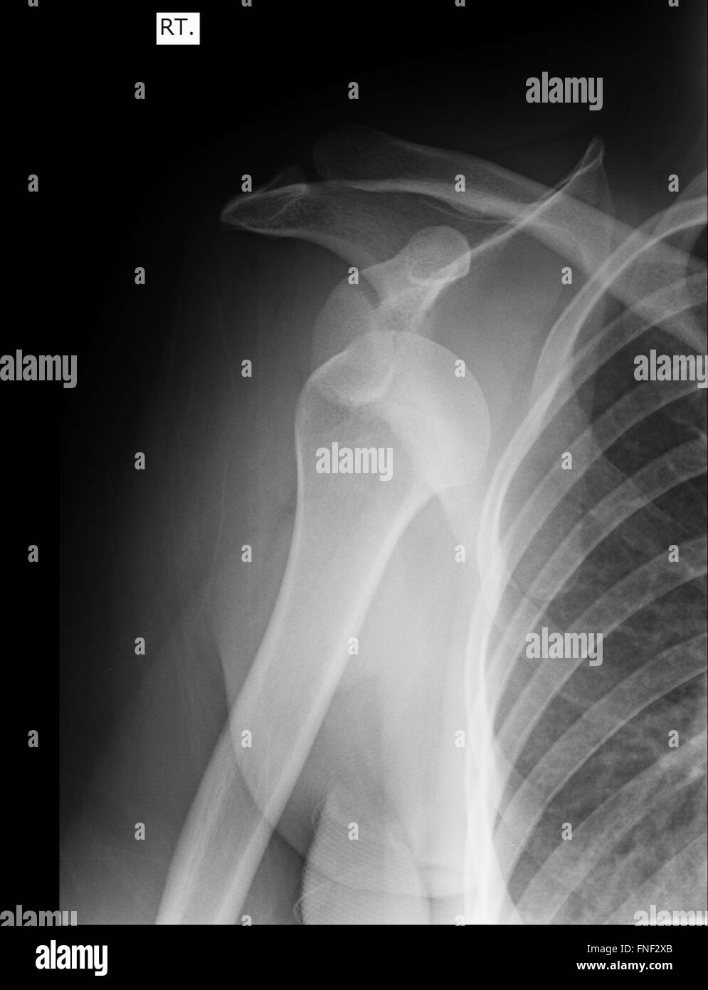 Shoulder Xray Stock Photos & Shoulder Xray Stock Images Alamy