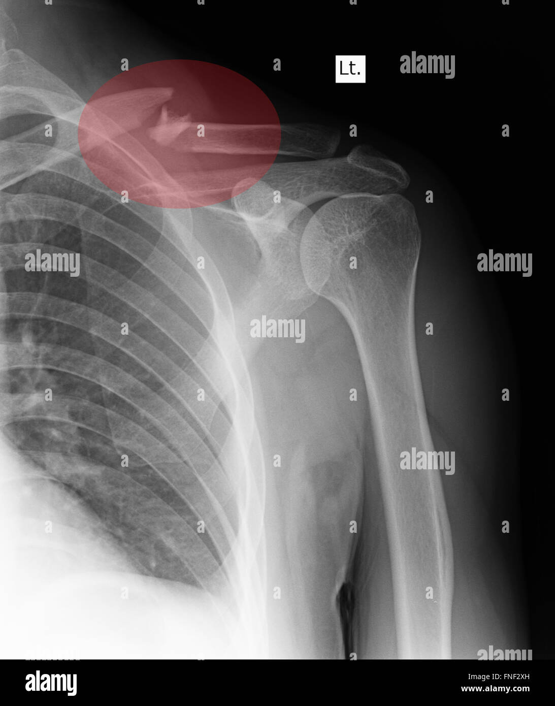 Shoulder xray hires stock photography and images Alamy