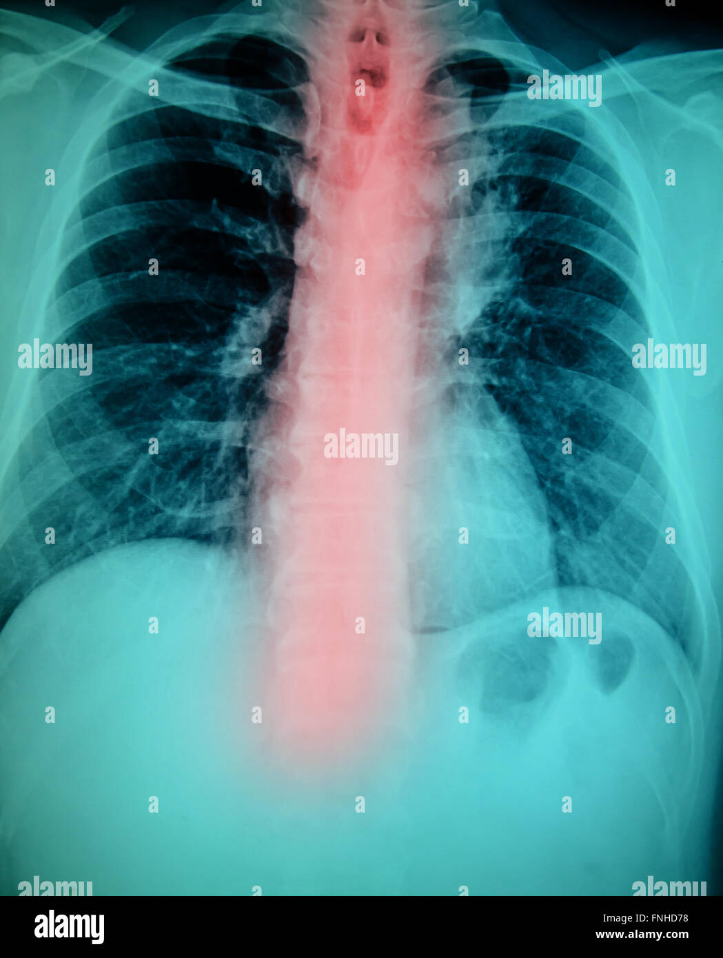 chest x-ray examination for diagnosis spine  injury Stock Photo