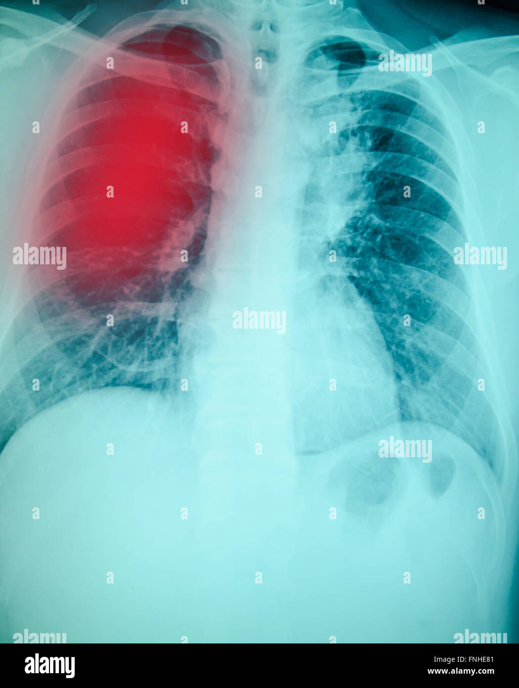 chest xray examination for diagnosis Pulmonary tuberculosis infection