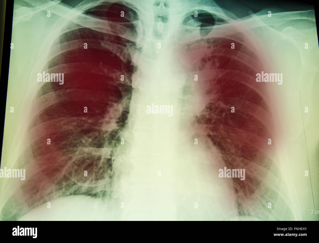 chest x-ray examination for diagnosis Pulmonary tuberculosis infection with  both  lung Stock Photo
