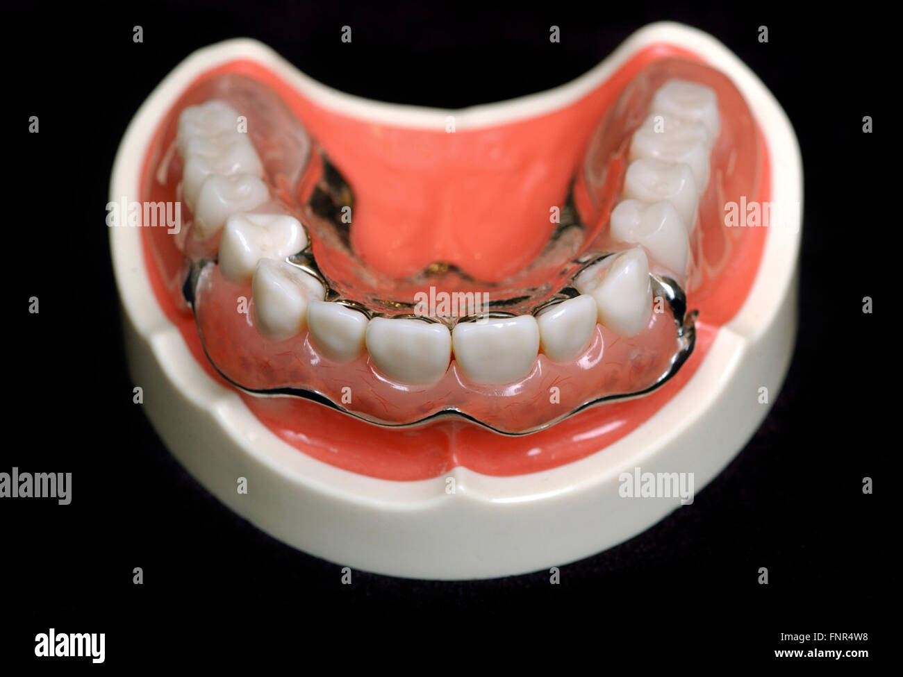 A set of dentures with a metal brace. Metal braces are designed to