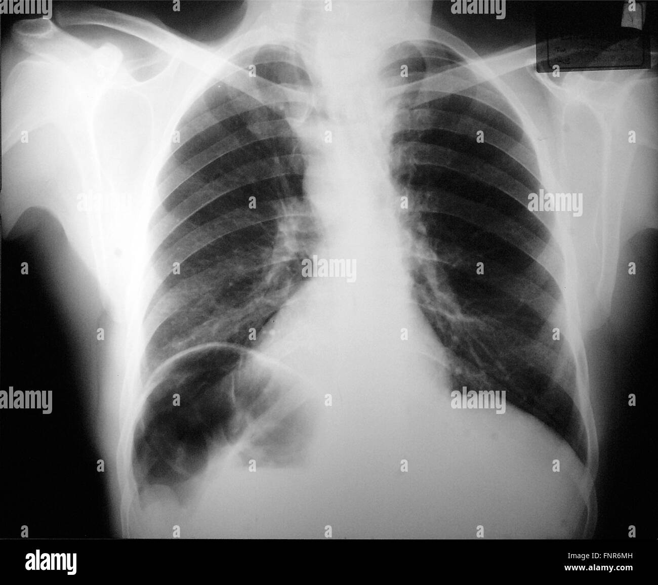 X-ray image through the upper chest showing a large multi nodular goitre and tracheal deviation. Stock Photo
