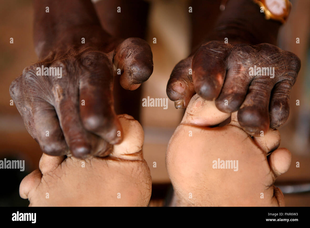 Leprosy patient known also as Leper,a disease called by Mycobacterium Leprae. Stock Photo