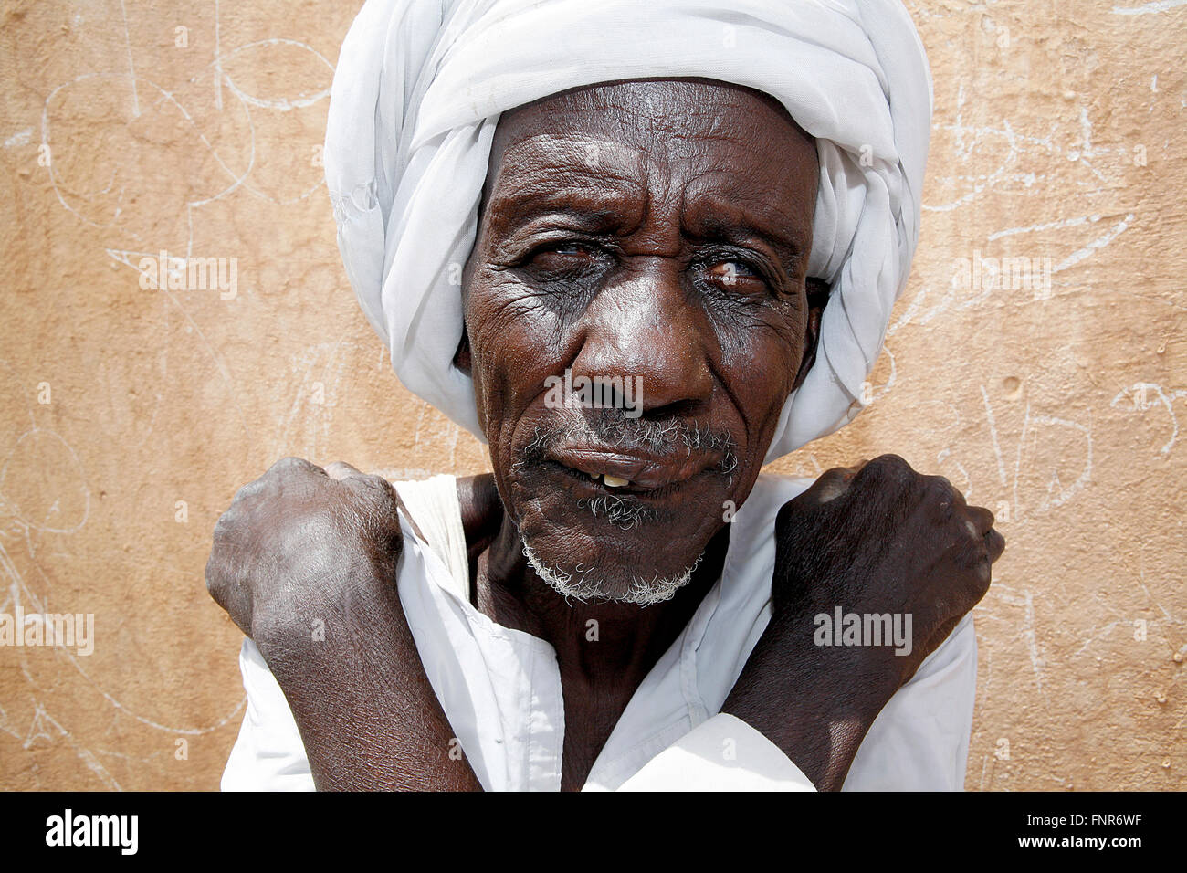 Leprosy patient known also as Leper,a disease called by Mycobacterium Leprae. Stock Photo