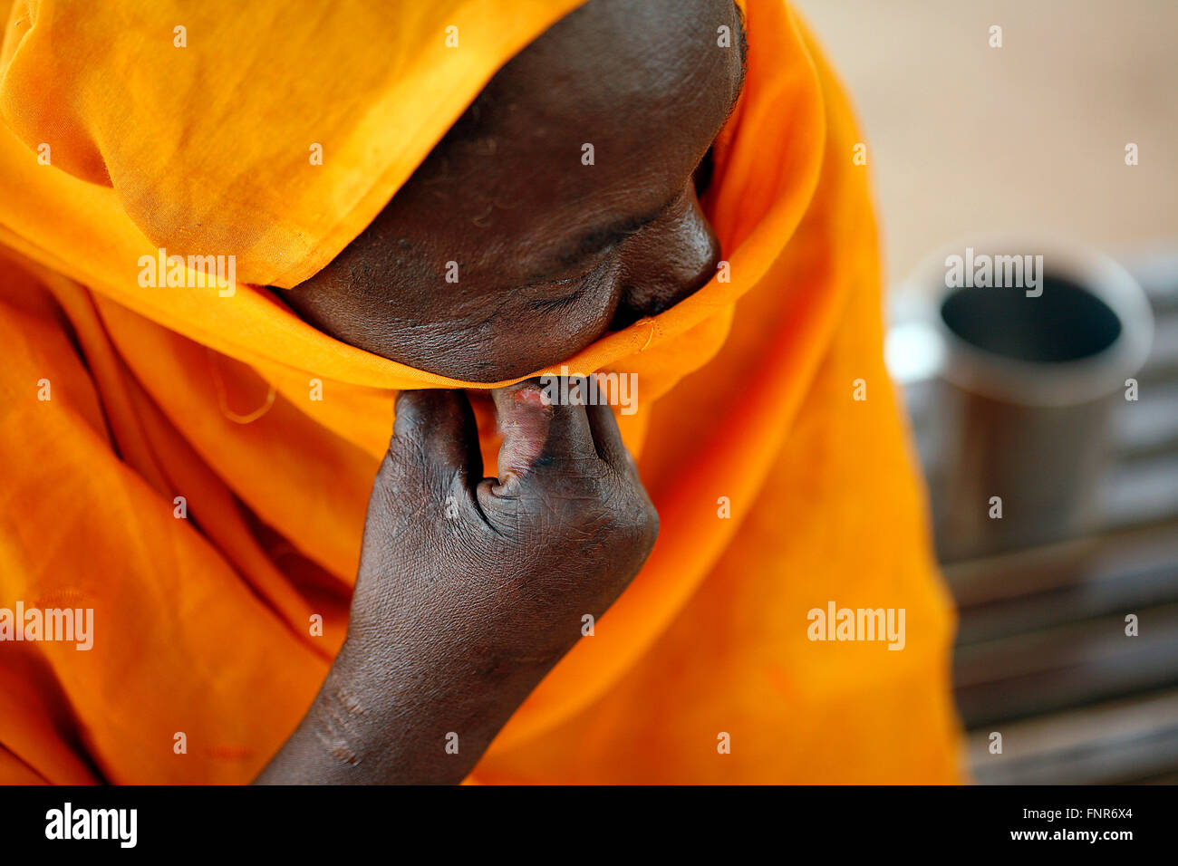 Leprosy patient known also as Leper,a disease called by Mycobacterium Leprae. Stock Photo