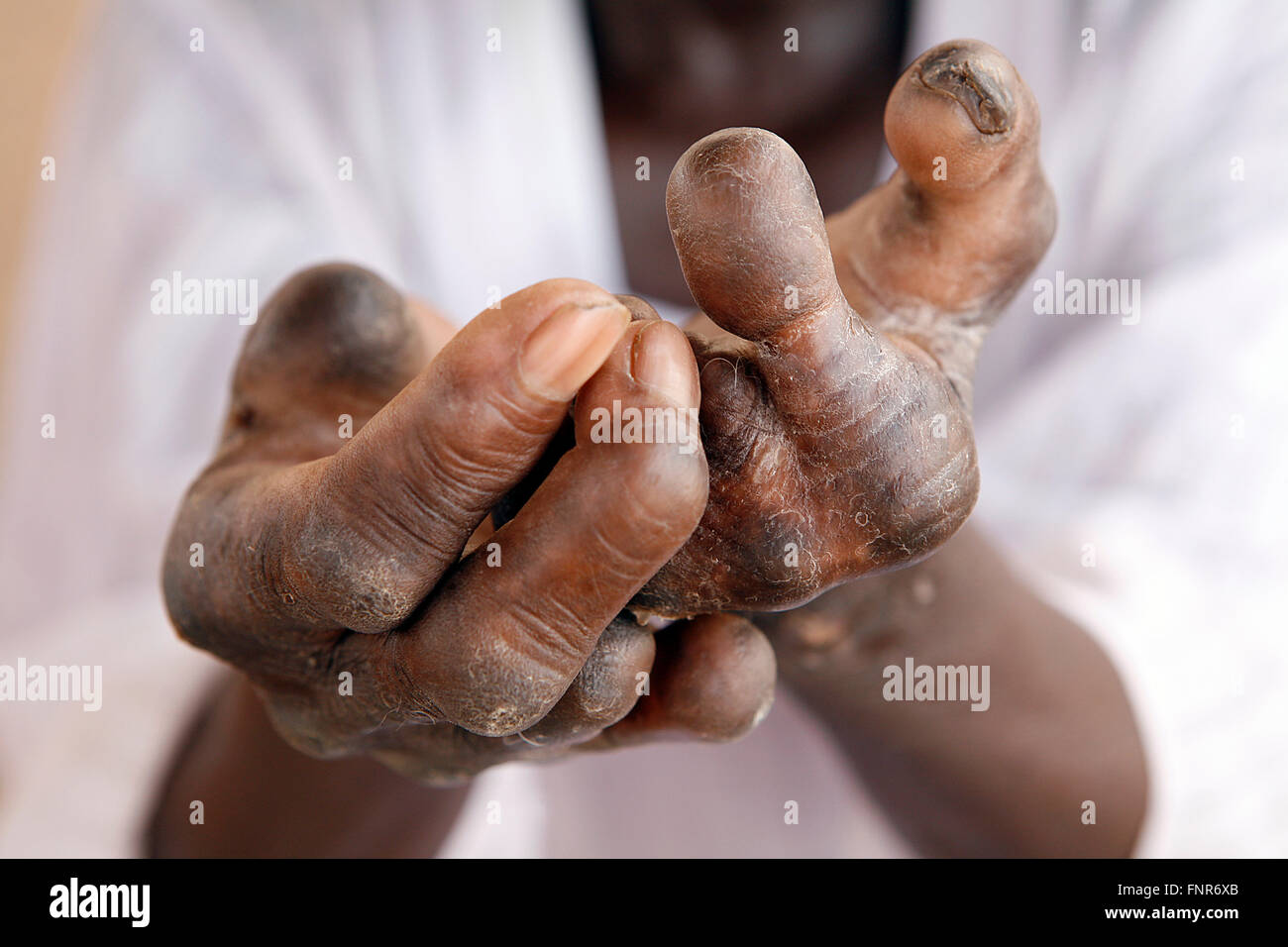 A Leper's badly deformed hands-Leprosy is a chronic inflammatory disease. Stock Photo