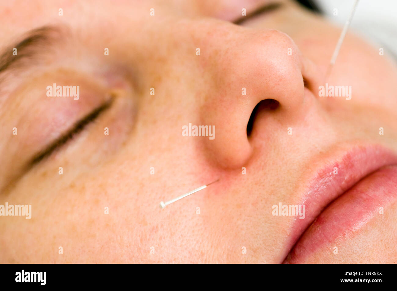 Acupuncture needles, as fine as hair, being inserted into the face of a