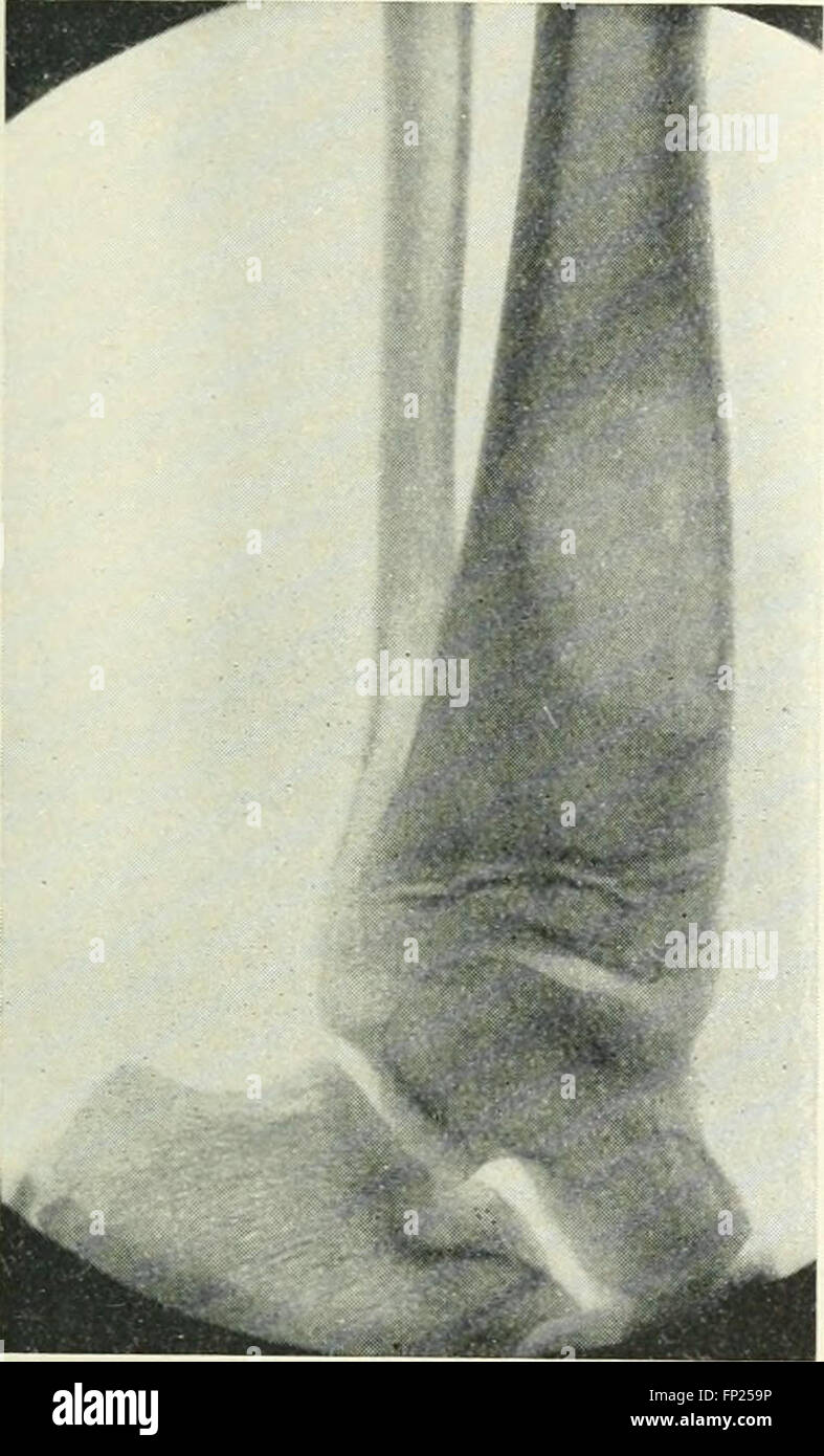 This 1915 work discusses the use of radiography, X-ray therapeutics ...