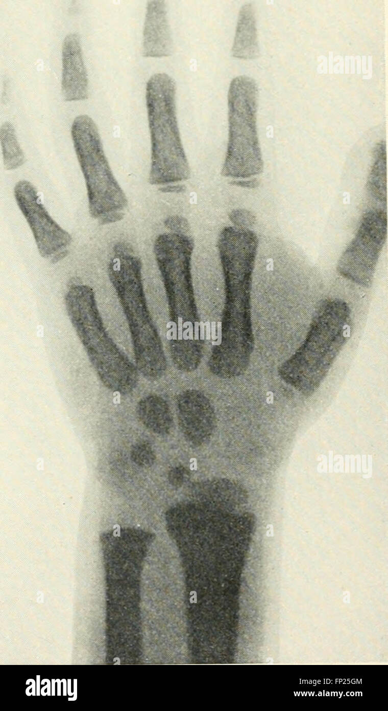 This 1915 work focuses on the use of radiography, X-ray therapy, and ...