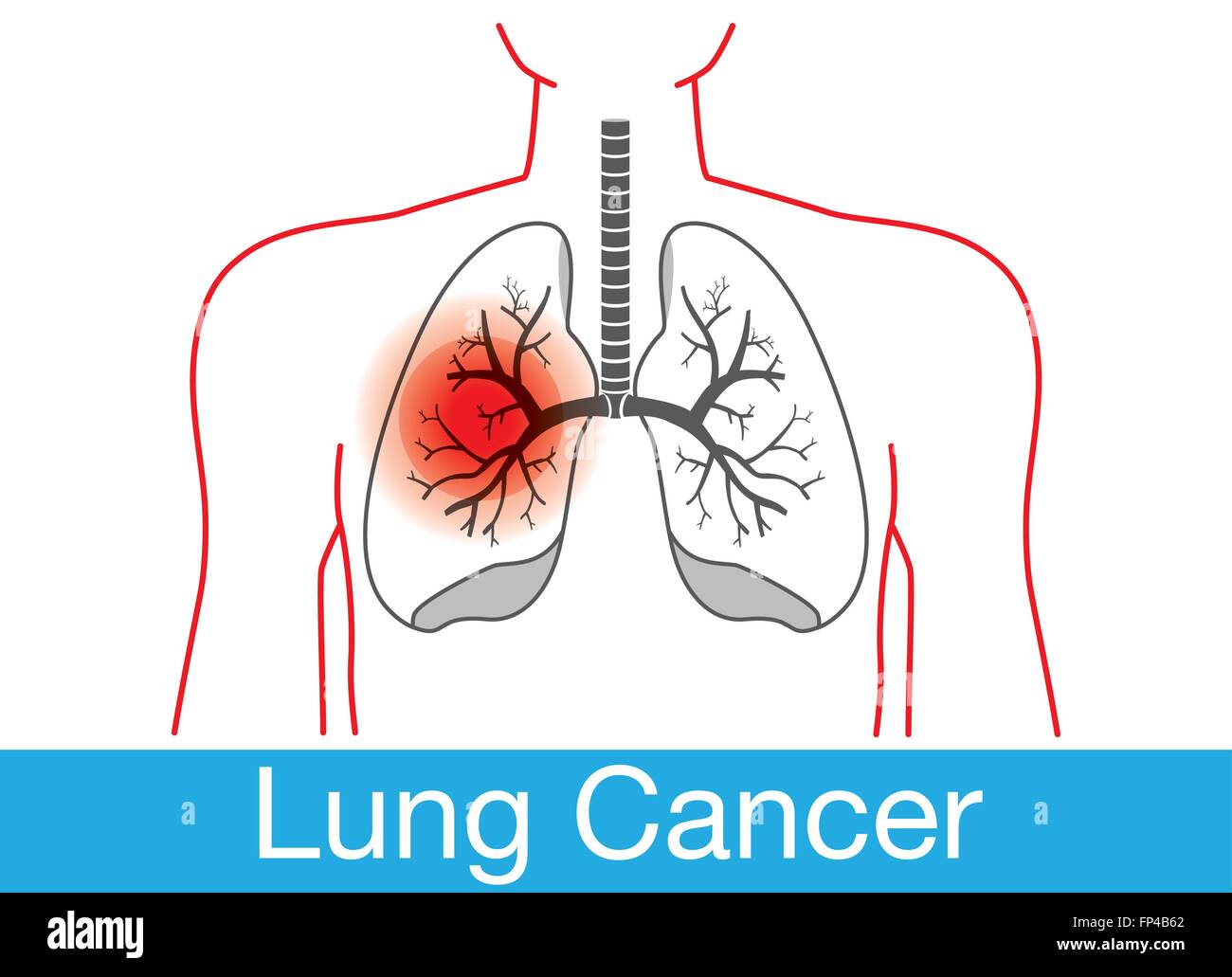 Lung cancer notification Stock Vector