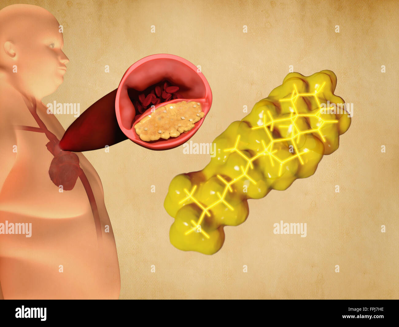 Cholesterol   atherosclerosis. Illustrati  of a molecular model of cholesterol (yellow) with a human figure   a cutaway view of Stock Photo