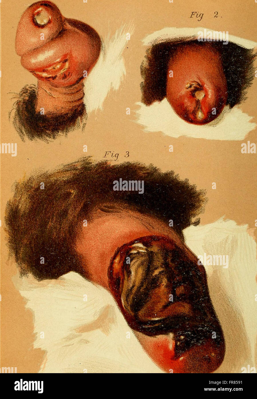 Old syphilis hi-res stock photography and images - Alamy
