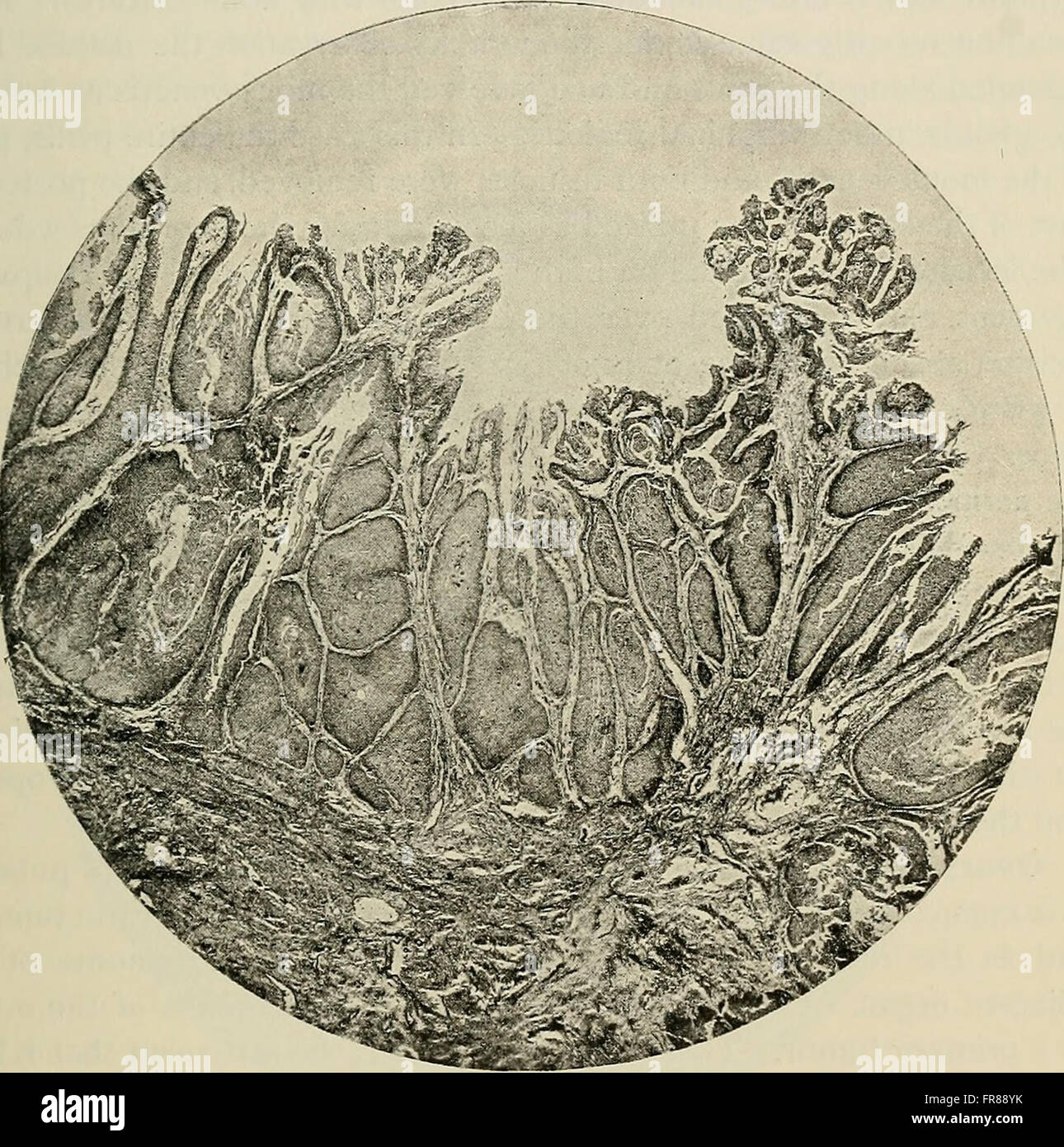 This 1895 text provides an in-depth look at the pathology of tumors and ...