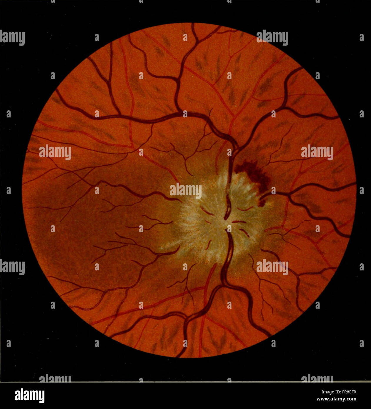 Atlas and epitome of ophthalmoscopy and ophthalmoscopic diagnosis (1910