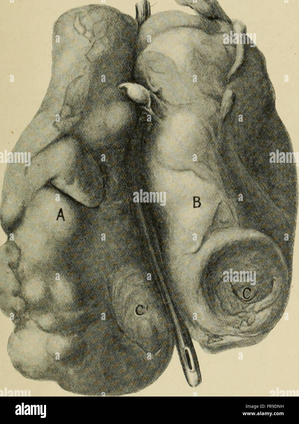 Clinical lectures on the surgical diseases of the urinary organs (1908 ...