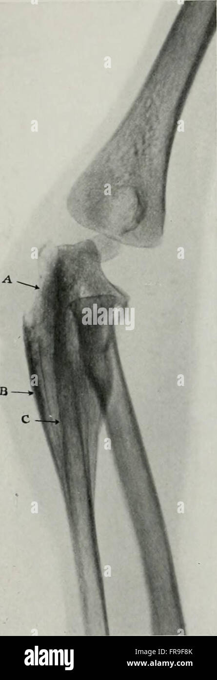 Living anatomy and pathology; the diagnosis of diseases in early life by the Roentgen method (1910) Stock Photo