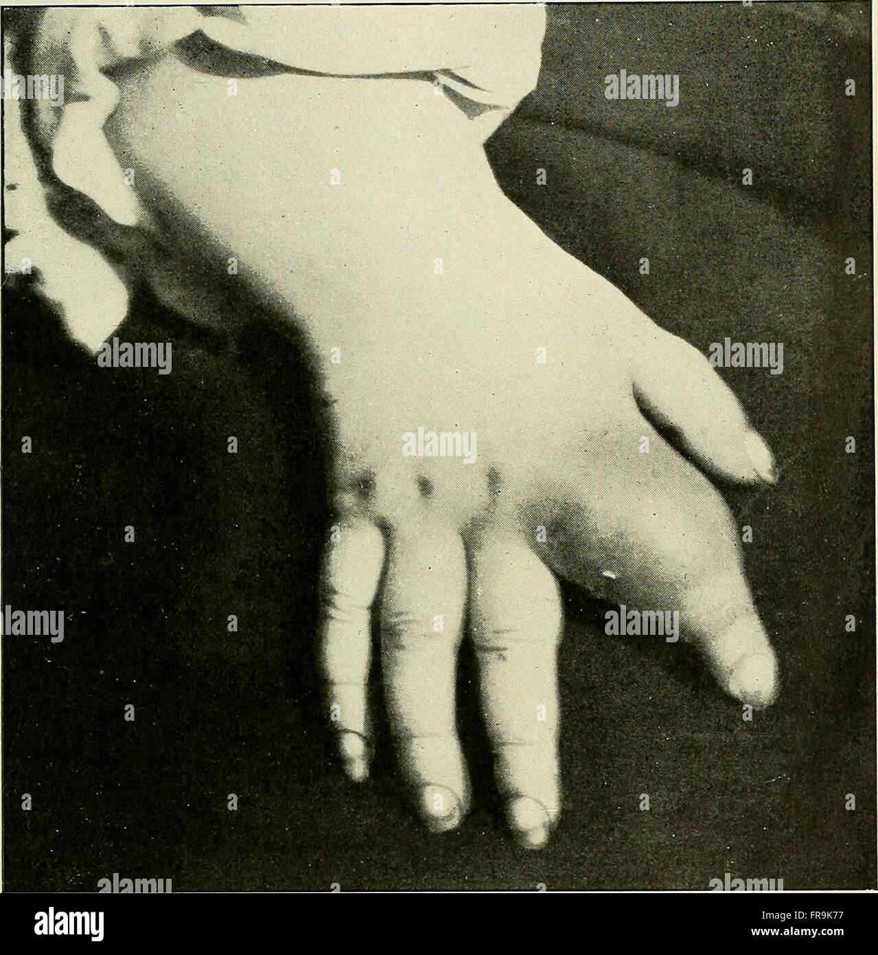 Recherche et diagnostic de l'hC3A9rC3A9do-syphilis tardive (1907) Stock Photo