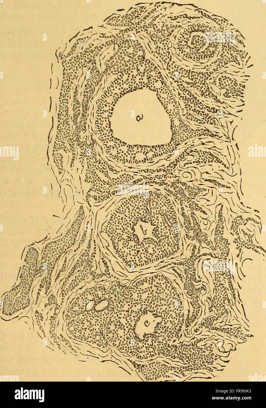 Syphilis Decomposition This 1886 work provides an overview of the pathology, symptoms, and ...