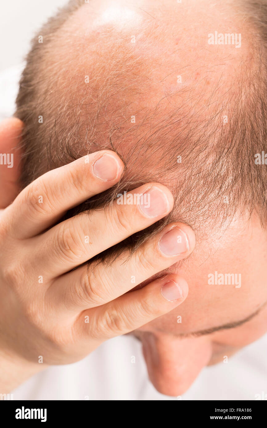 Baldness Alopecia man hair loss Stock Photo