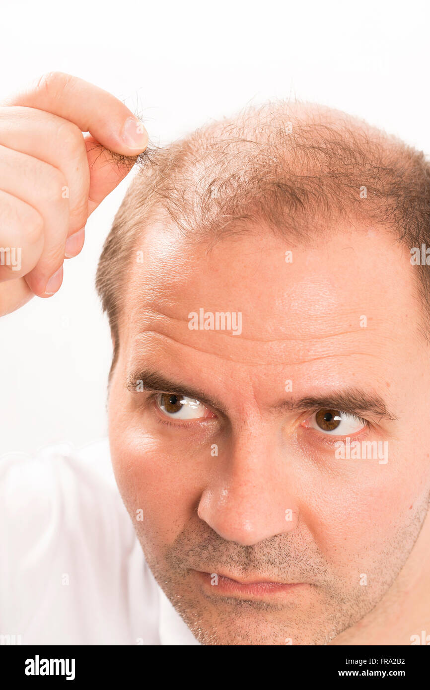 Baldness Alopecia man hair loss Stock Photo