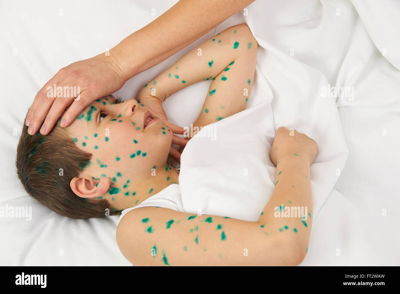 Профилактика при ветряной оспе. Лечение ветряной оспы у детей. Профилактика ветрянки после контакта. Профилактика ветрянки после контакта. Профилактика ветрянки после контакта.