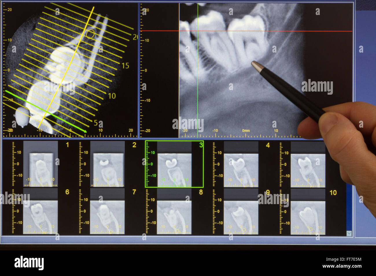 Doctor indicating a wisdom tooth on Xray computed tomography Stock