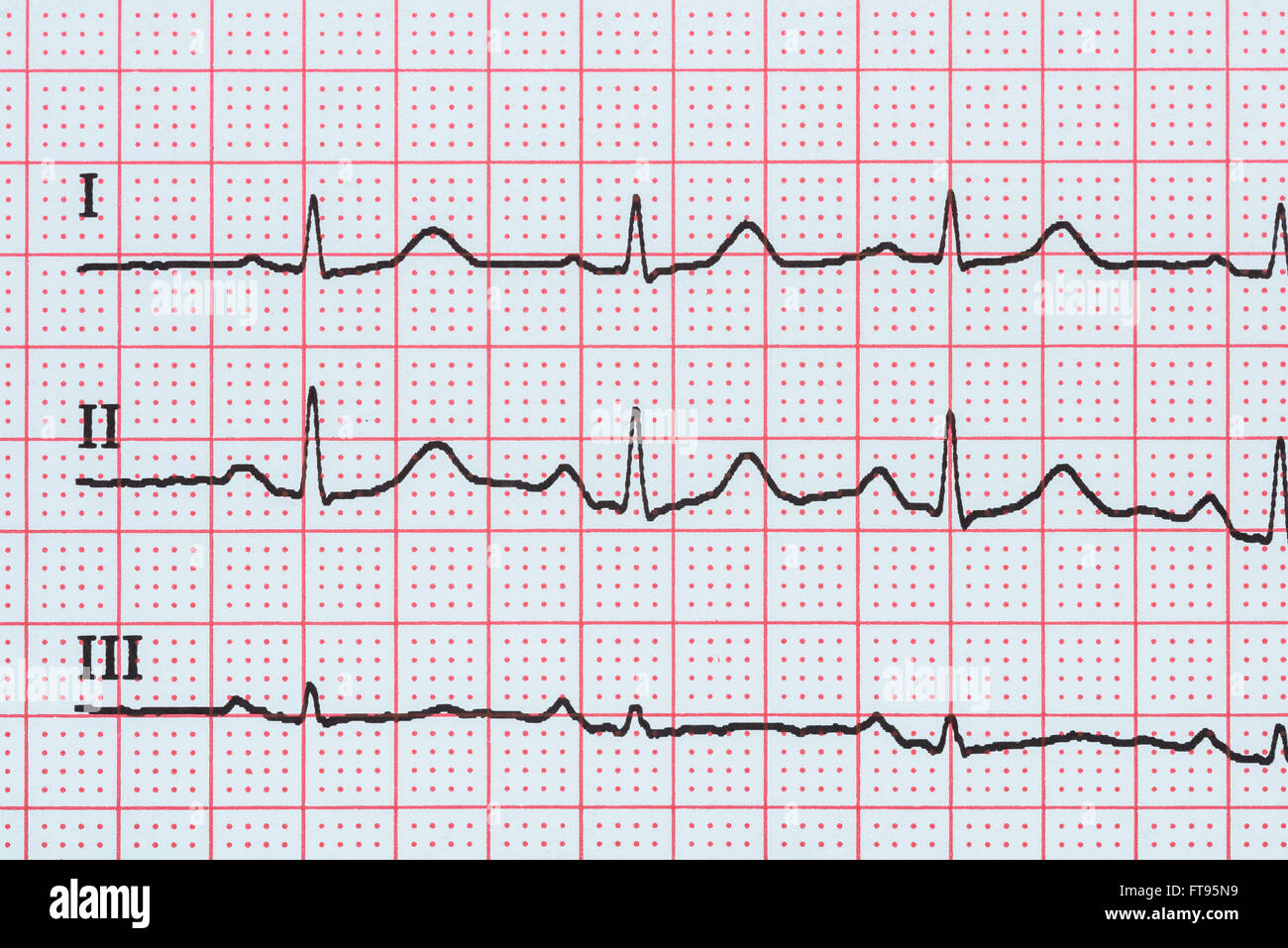 Sinus Heart Rhythm On Electrocardiogram Record Paper Showing Normal P