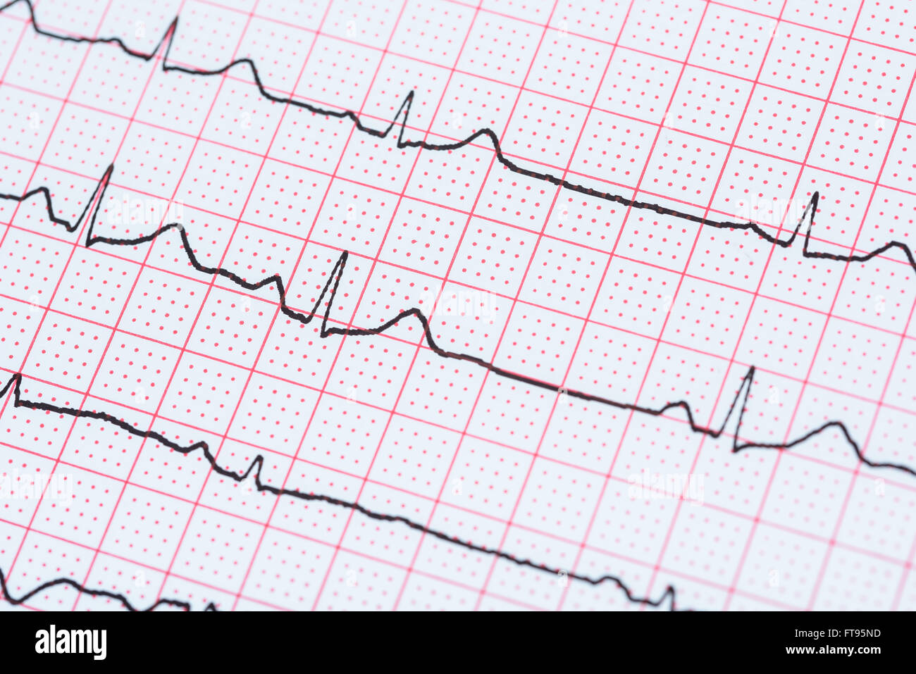 Sinus Heart Rhythm On Electrocardiogram Record Paper Showing Normal P Wave, PR and QT Interval and QRS Complex Stock Photo