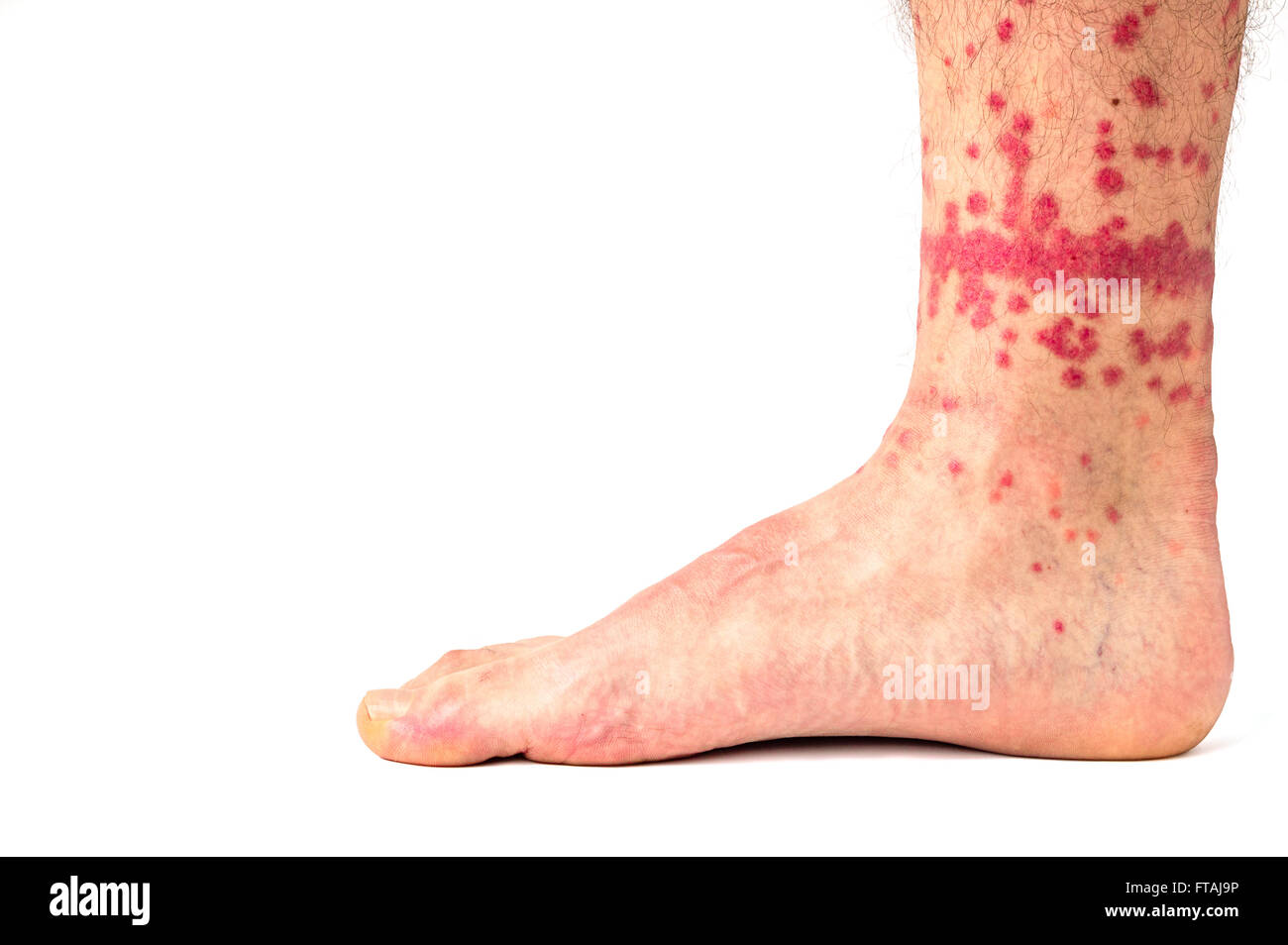 Extreme case of flea bites on humans Stock Photo Alamy