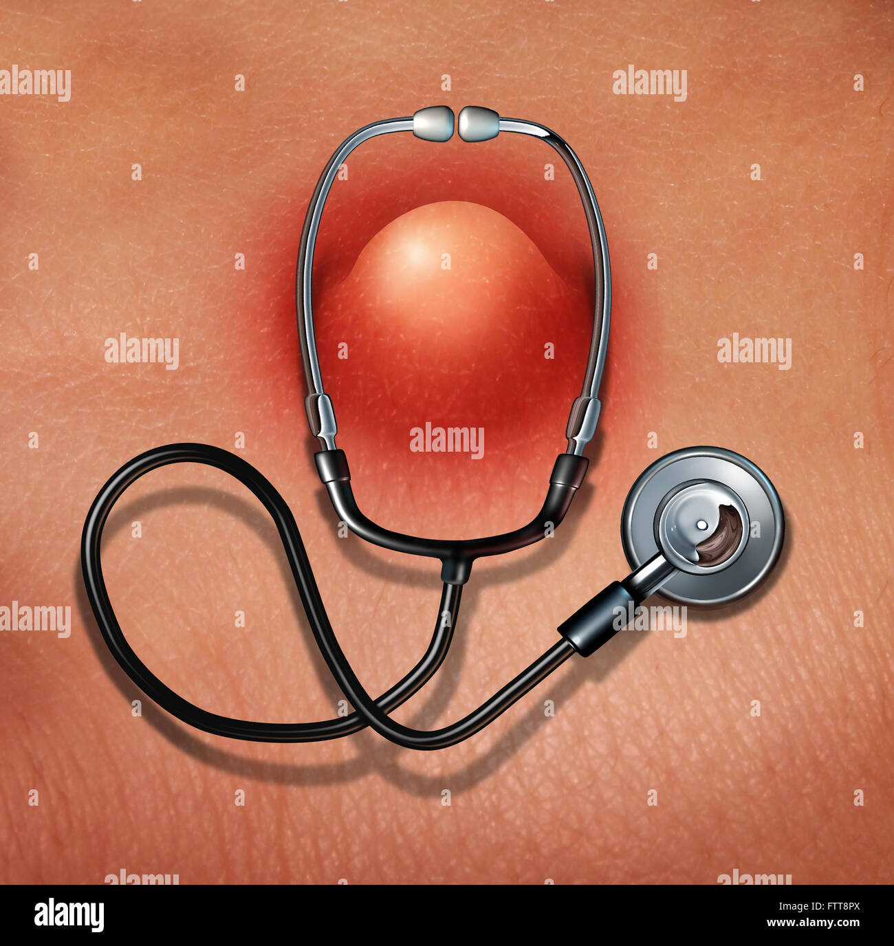 Dermatology skin medicine concept as a dermatologist doctor stethoscope wrapped arround a pimple as a medical symbol for human skincare or diagnosis of epidermis symptoms. Stock Photo