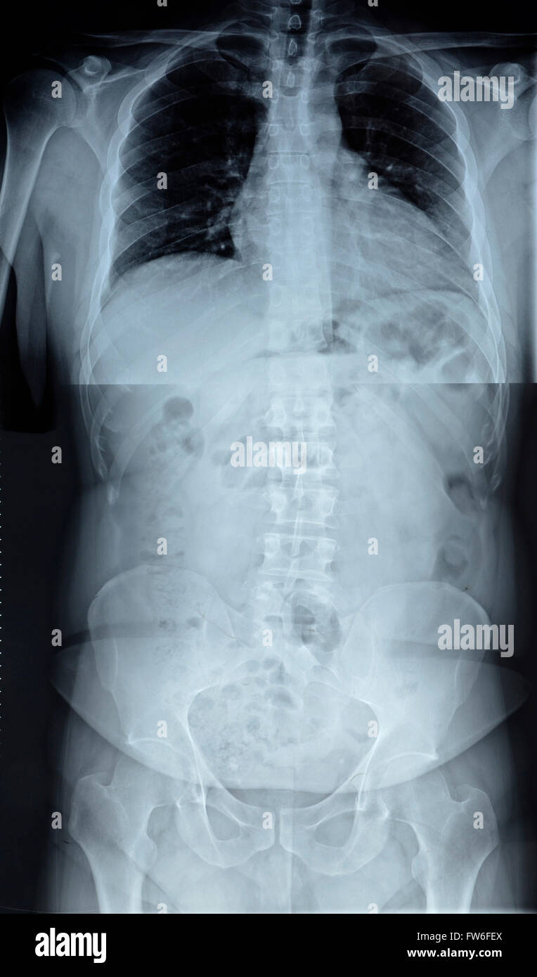 X-ray of the spinal column Stock Photo