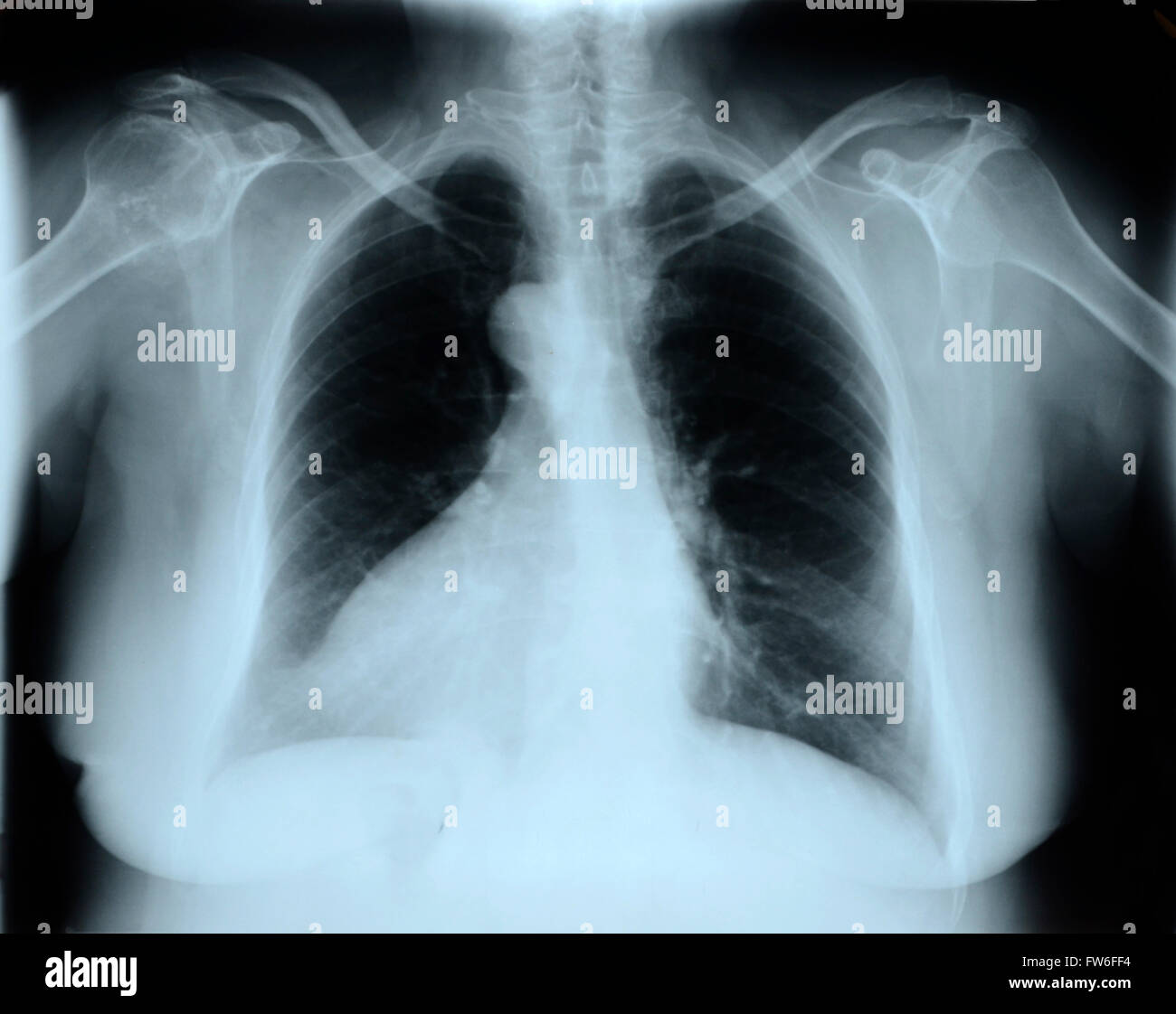 X-Ray Image Of Human Chest Stock Photo