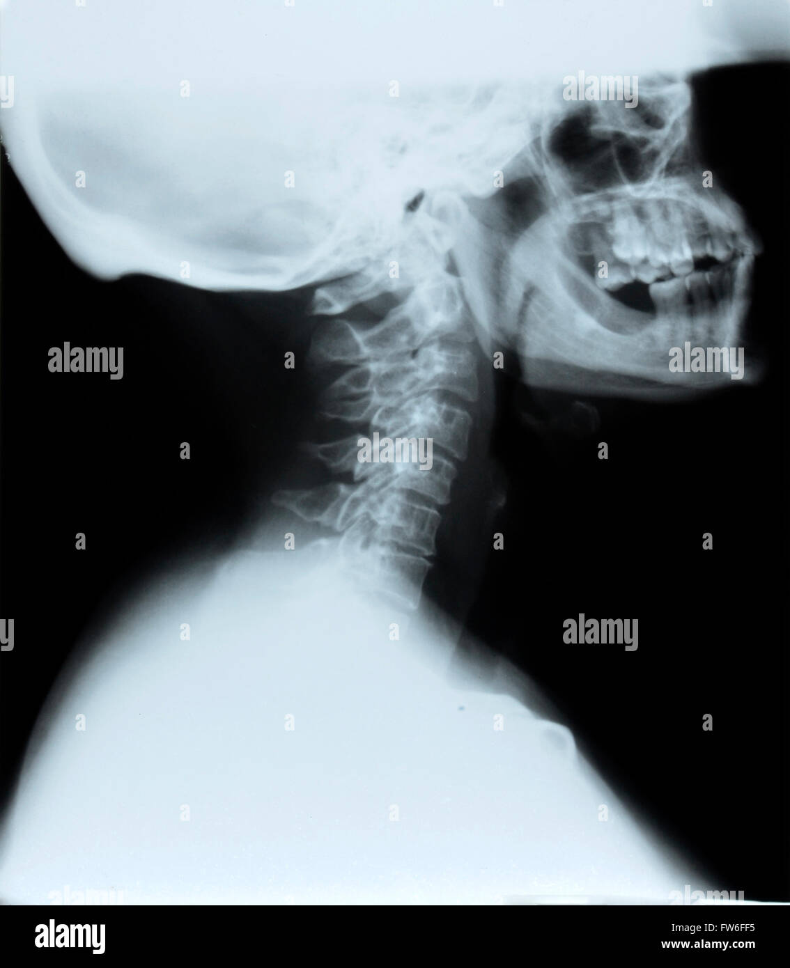 detail of neck and head x-ray image Stock Photo