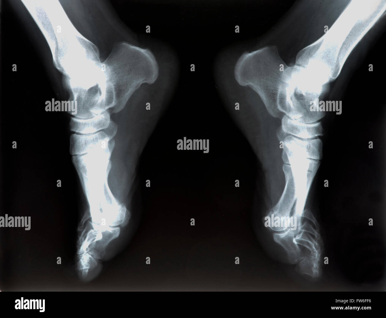 x-ray of foot Stock Photo