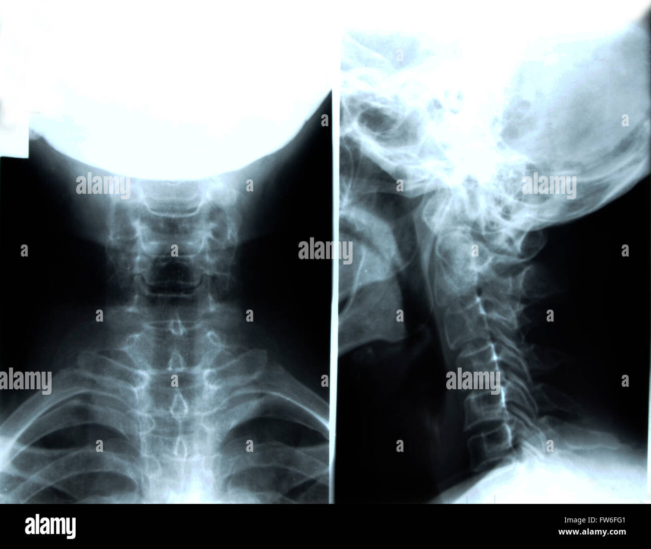 Head and neck x ray hires stock photography and images Alamy
