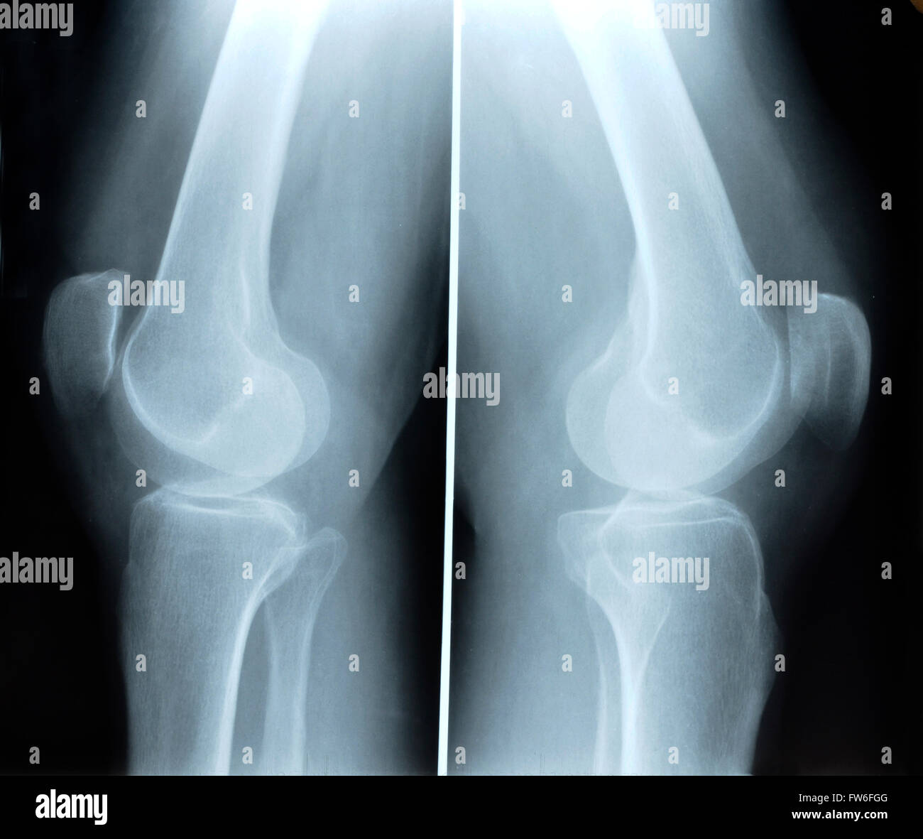 Broken leg x ray hi-res stock photography and images - Alamy