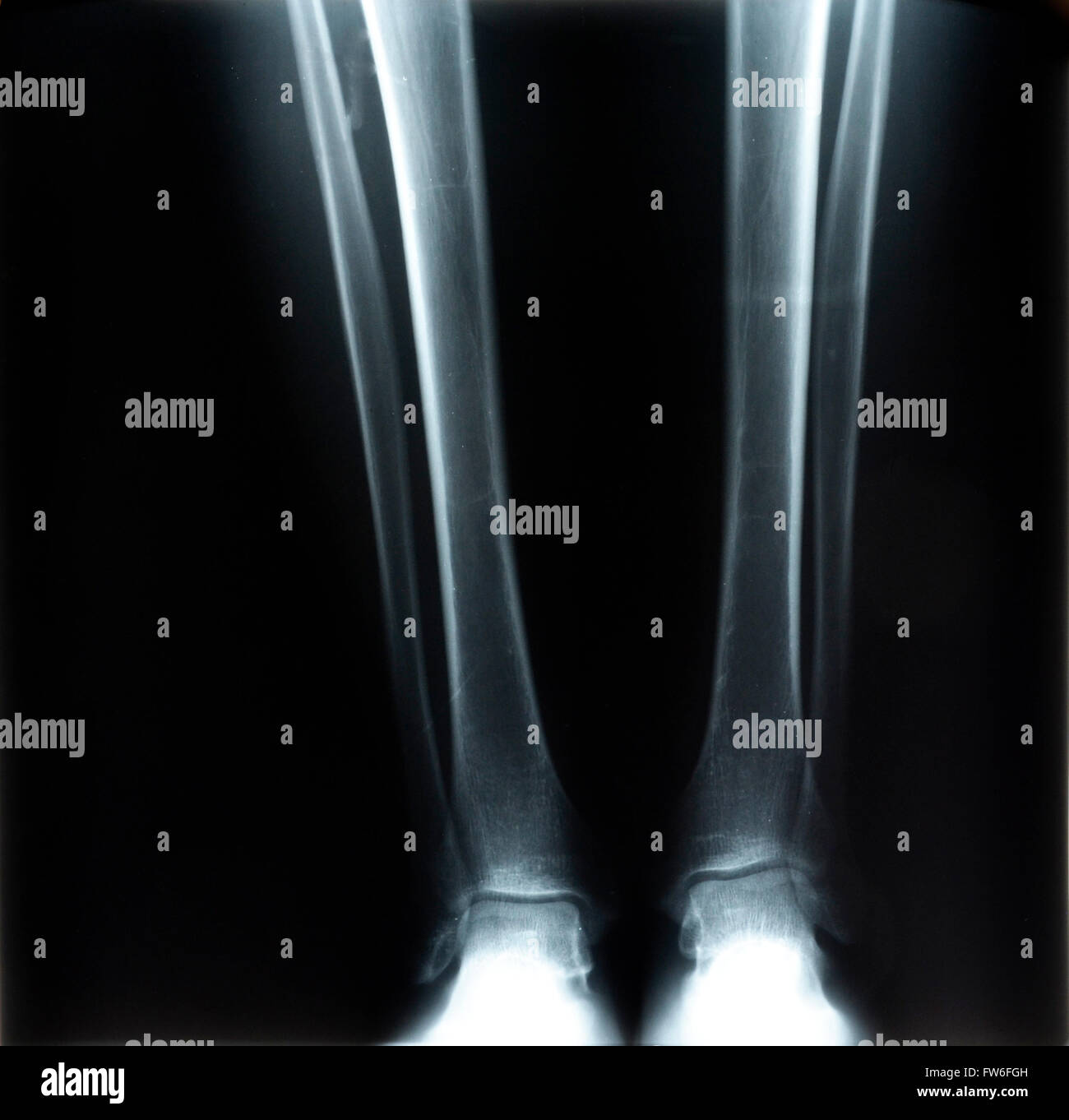 X-ray of both human legs Stock Photo