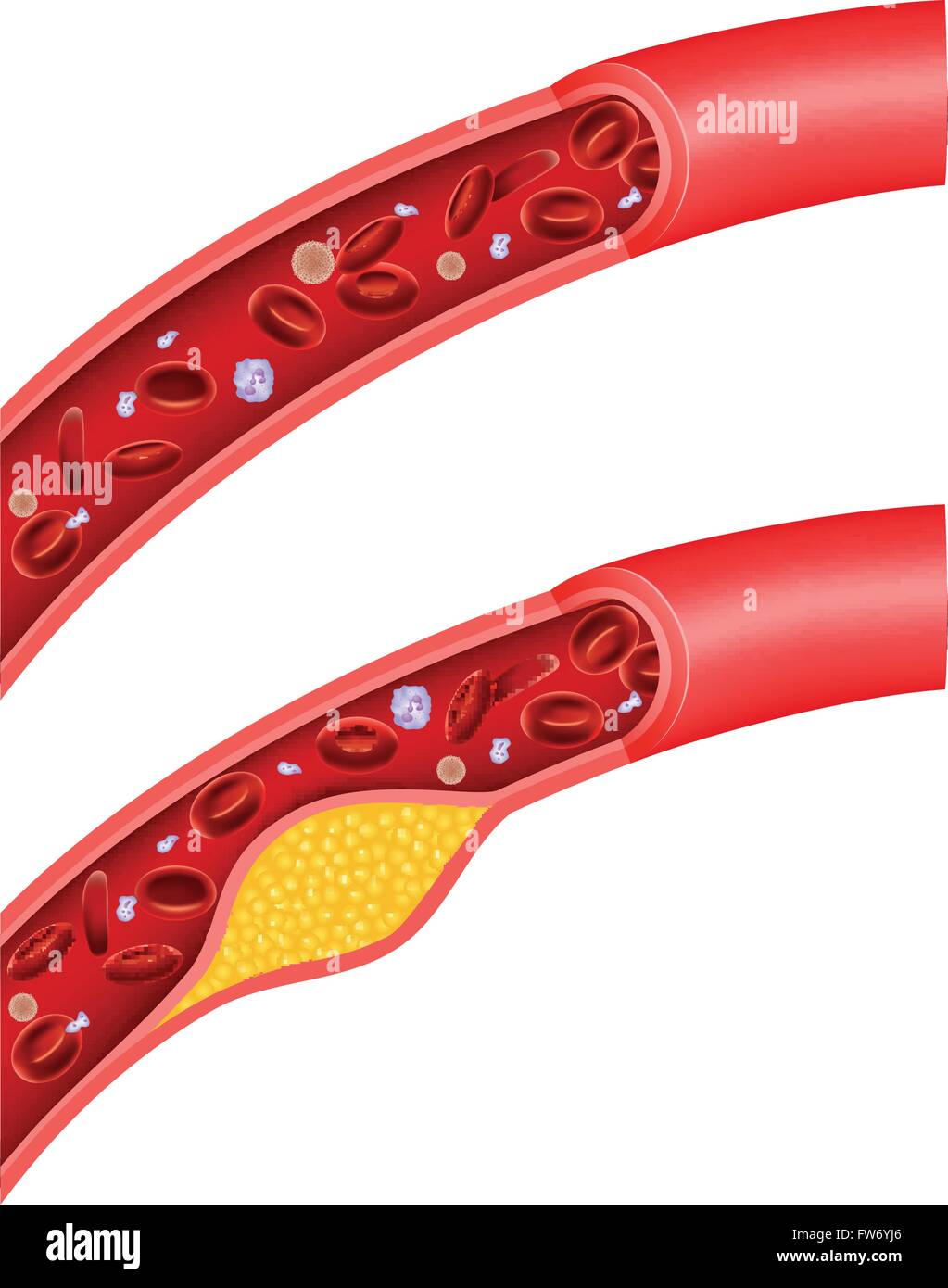 Illustration of cholesterol blocking artery Stock Vector