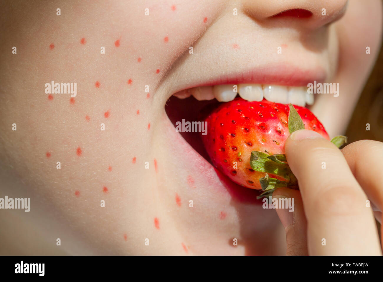 Allergy food strawberry and abstract allergic reaction on the girl's face closeup Stock Photo
