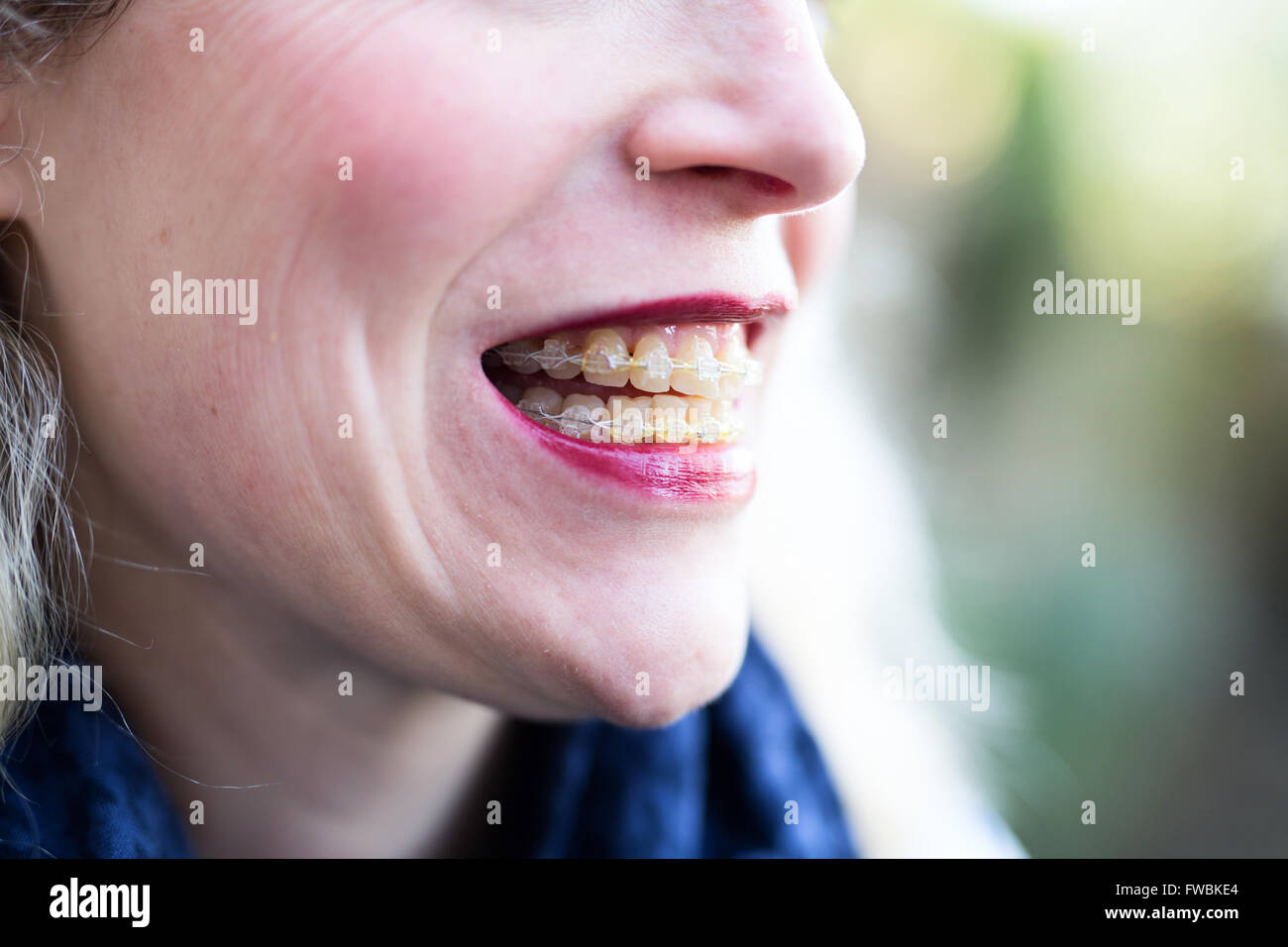 40 year old woman with braces hires stock photography and images Alamy