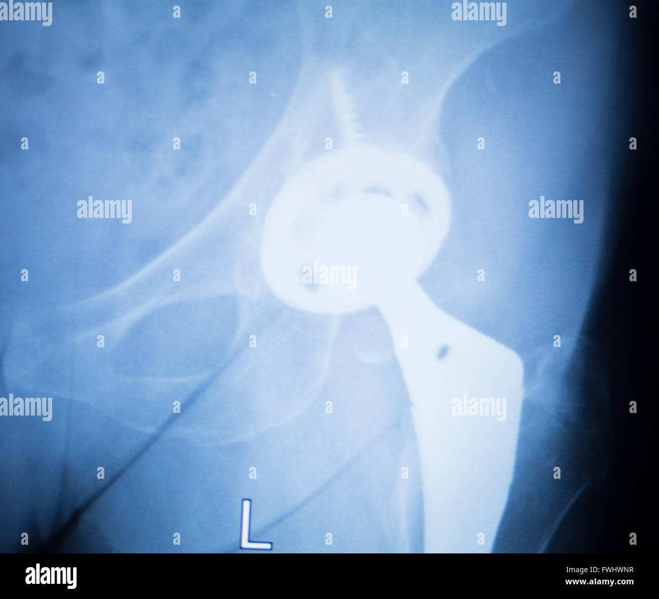 Hip replacement injury medical xray test scan result for adult showing