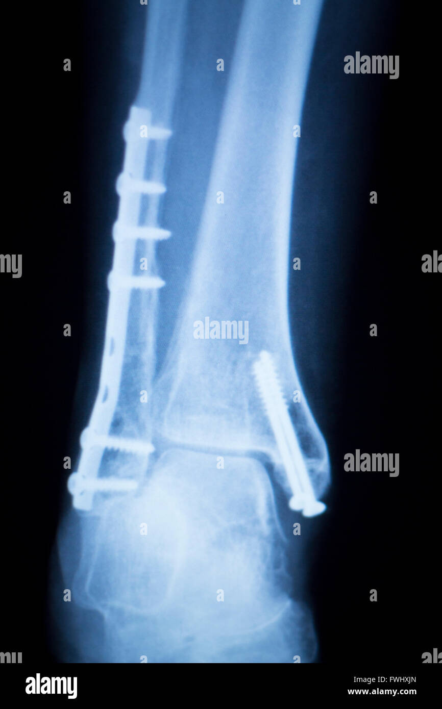 Titanium Plate In Leg