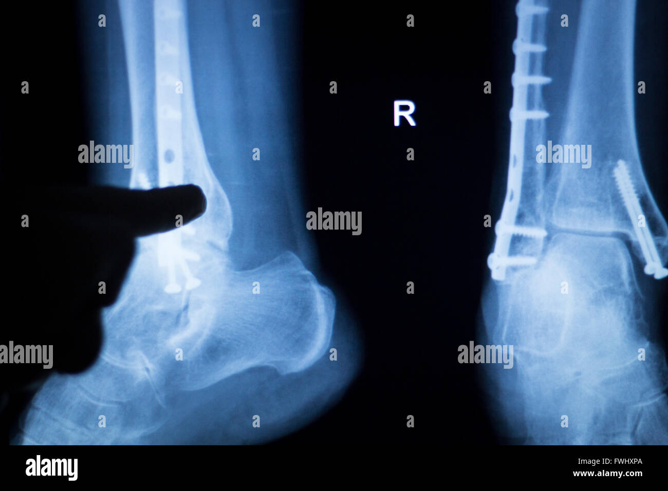 Ankle and leg injury medical xray test scan result for adult showing