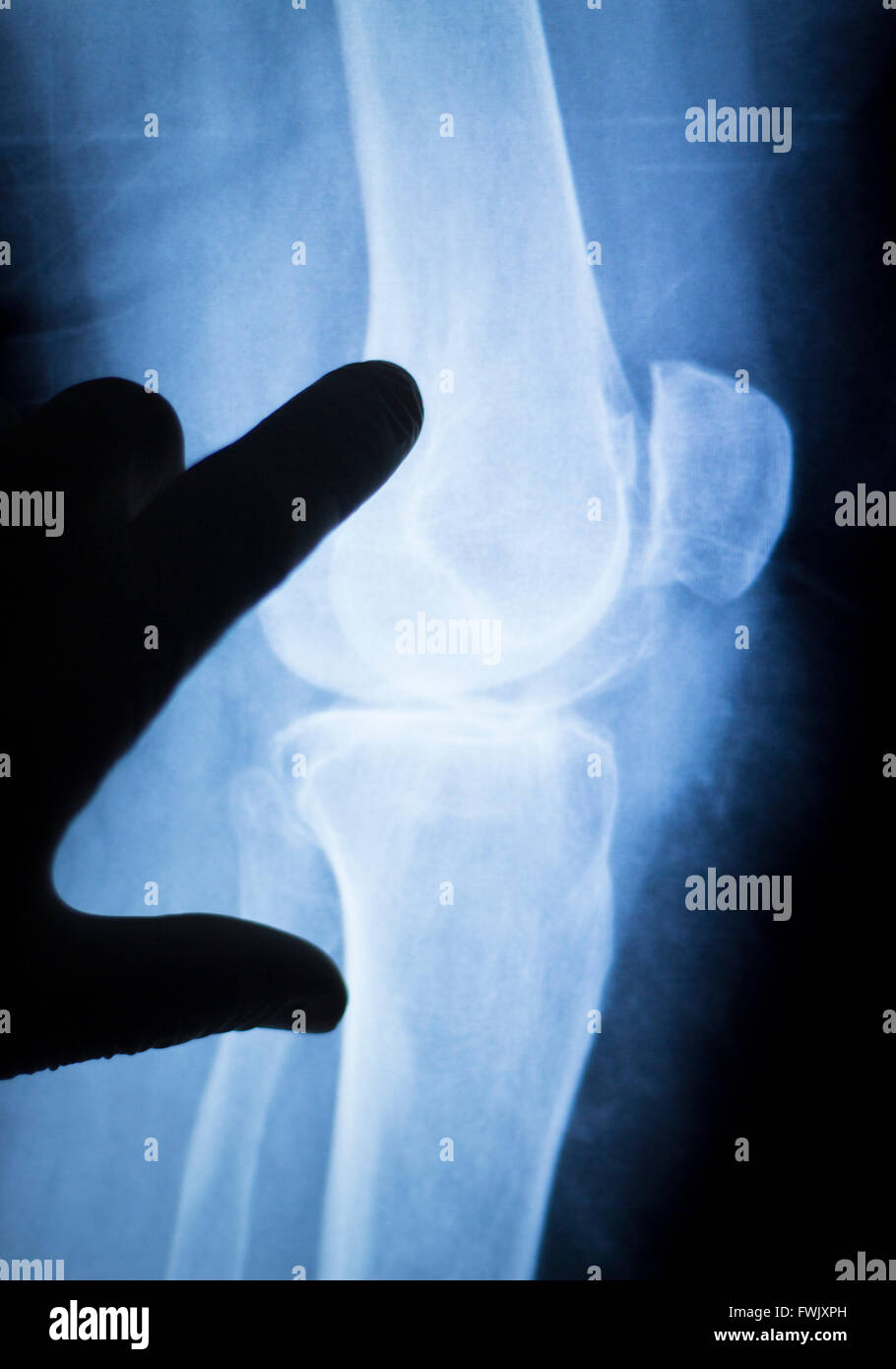 Knee and meniscus injury medical xray test scan result for adult showing surgeon indicating