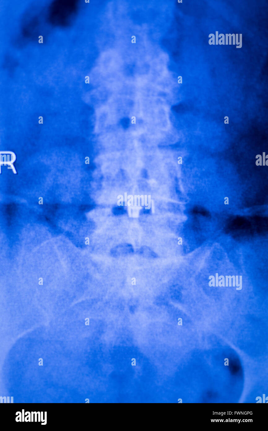 Spinal column, vertebra and back patient medical x-ray test scan result for adult showing orthopedic Traumatology titanium metal plate implant back pain image. Stock Photo