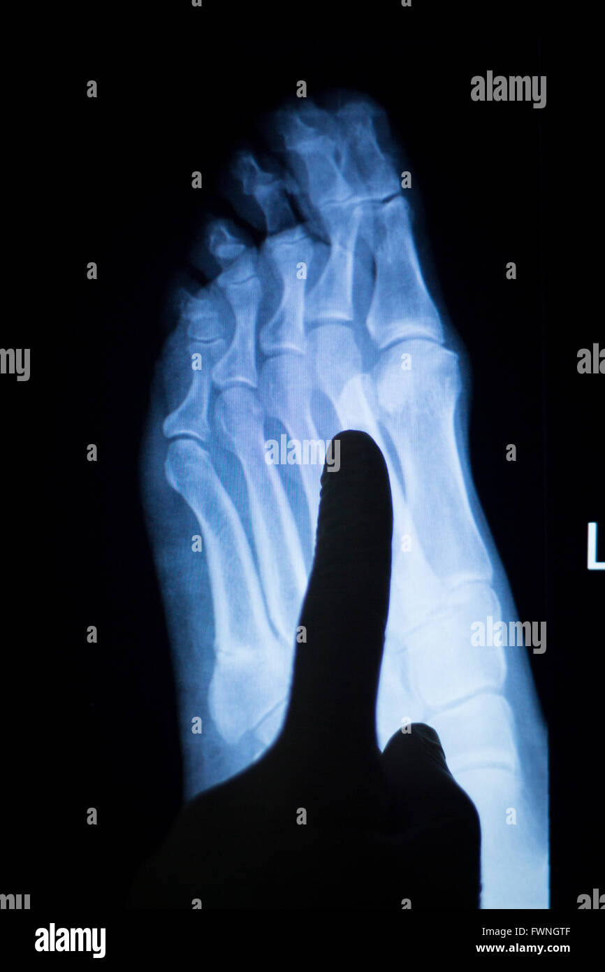 Foot and toes medical x-ray test scan result for adult showing orthopedic Traumatology titanium metal plate implant image. Stock Photo