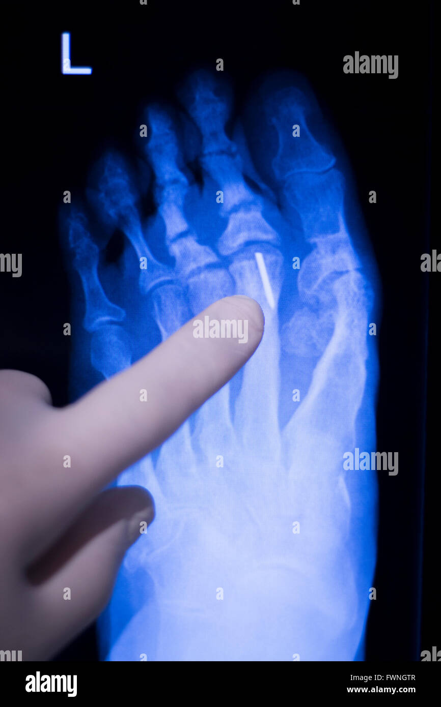 Foot and toes medical x-ray test scan result for adult showing orthopedic Traumatology titanium metal plate implant image. Stock Photo