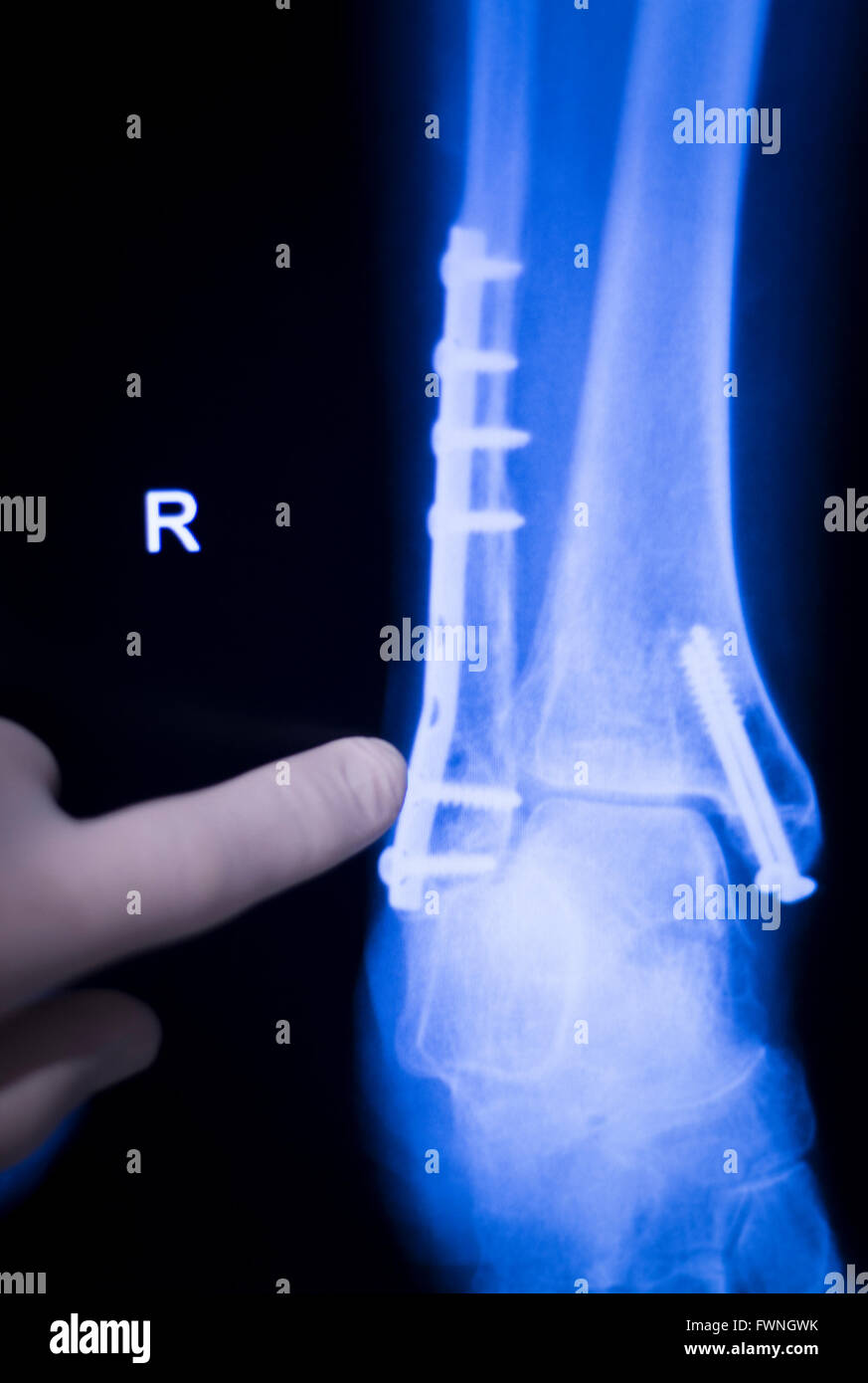 Foot, ankle and leg medical x-ray test scan result for adult showing orthopedic Traumatology titanium metal plate implant image. Stock Photo