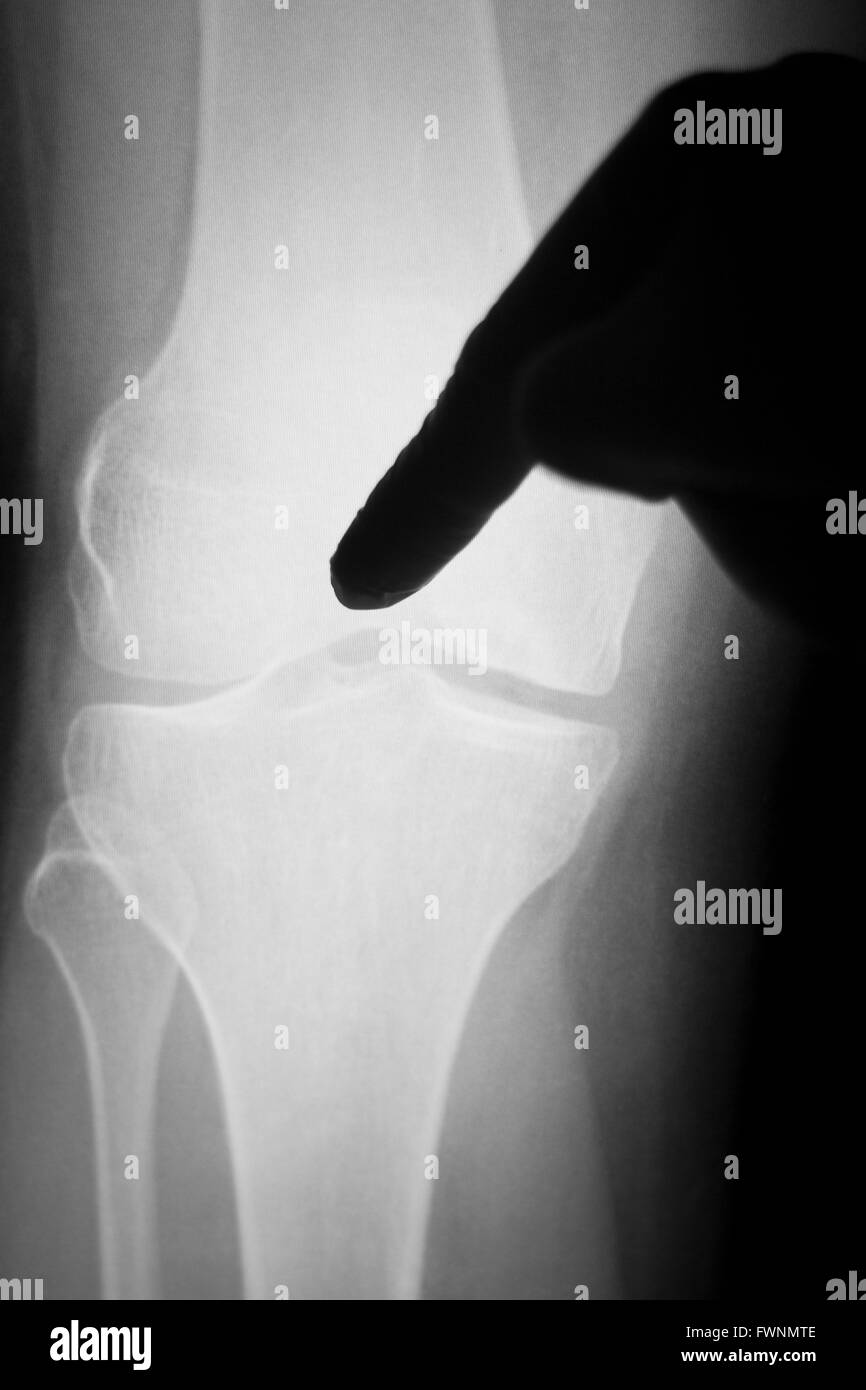 Knee and meniscus injury medical x-ray test scan result for adult showing surgeon indicating point of lesion. Stock Photo